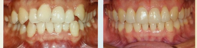 before and after picture from patient using Invisalign